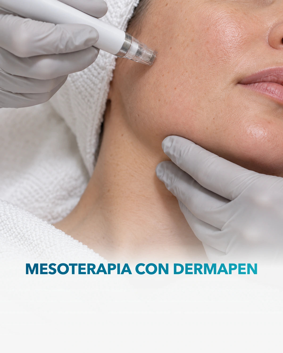 Mesoterapia con Dermapen — procedimiento en Clínica Adhara